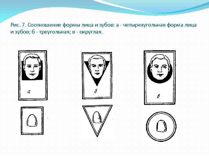 Рис. 7. Соотношение формы лица и зубов: а - четырехугольная форма лица и зубов;