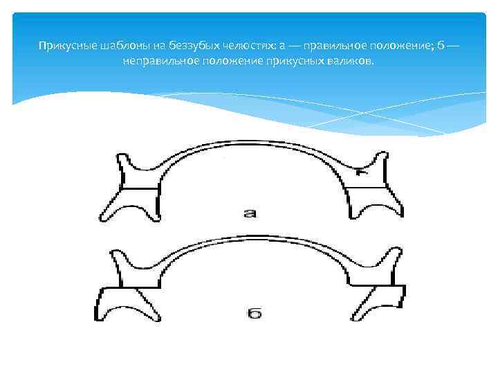 Прикусные шаблоны на беззубых челюстях: а — правильное положение; б — неправильное положение прикусных