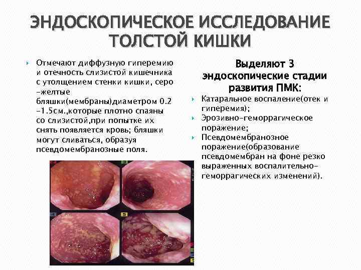 ЭНДОСКОПИЧЕСКОЕ ИССЛЕДОВАНИЕ ТОЛСТОЙ КИШКИ Отмечают диффузную гиперемию и отечность слизистой кишечника с утолщением стенки