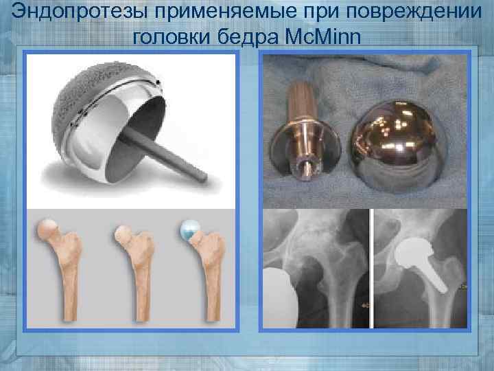 Головка эндопротеза. Виды эндопротезов. Различают эндопротезы. Головки эндопротеза Размеры.