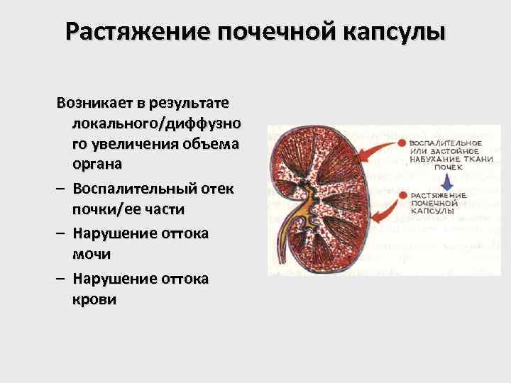 Растяжение почечной капсулы Возникает в результате локального/диффузно го увеличения объема органа – Воспалительный отек