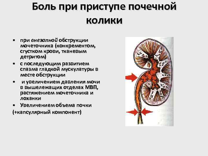 Боль приступе почечной колики • при внезапной обструкции мочеточника (конкрементом, сгустком крови, тканевым детритом)