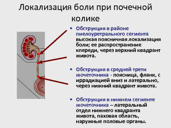 Локализация боли при почечной колике • Обструкция в районе пиелоуретрального сегмента высокая поясничная локализация