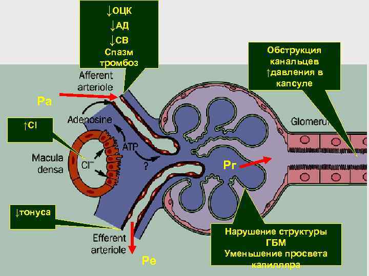 ↓ОЦК ↓АД ↓СВ Обструкция канальцев ↑давления в капсуле Спазм тромбоз Ра ↑Сl Рг ↓тонуса