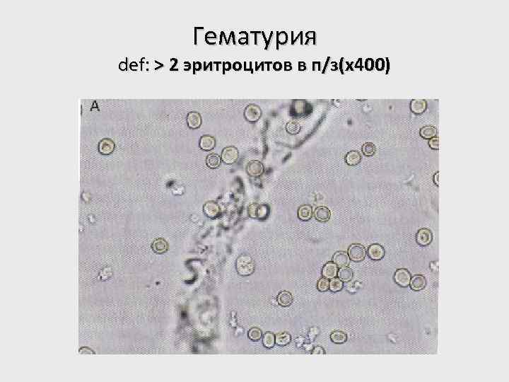 Гематурия def: > 2 эритроцитов в п/з(x 400) 