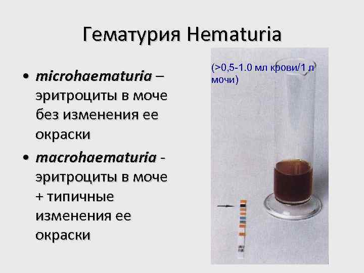 Гематурия Hematuria • microhаematuria – эритроциты в моче без изменения ее окраски • macrohаematuria