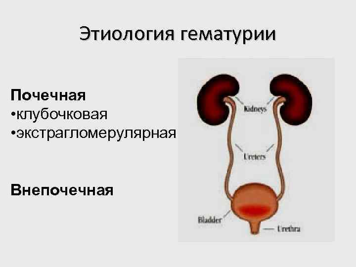 Этиология гематурии Почечная • клубочковая • экстрагломерулярная Внепочечная 