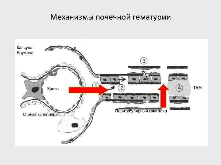 Механизмы почечной гематурии 