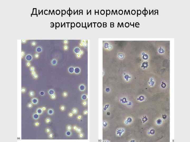 Дисморфия и нормоморфия эритроцитов в моче 