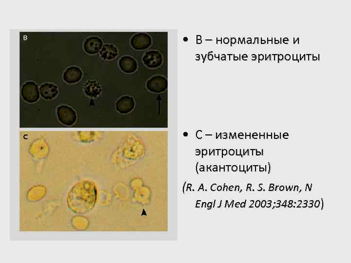  • В – нормальные и зубчатые эритроциты • С – измененные эритроциты (акантоциты)