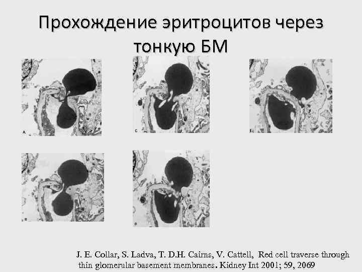 Прохождение эритроцитов через тонкую БМ J. E. Collar, S. Ladva, T. D. H. Cairns,