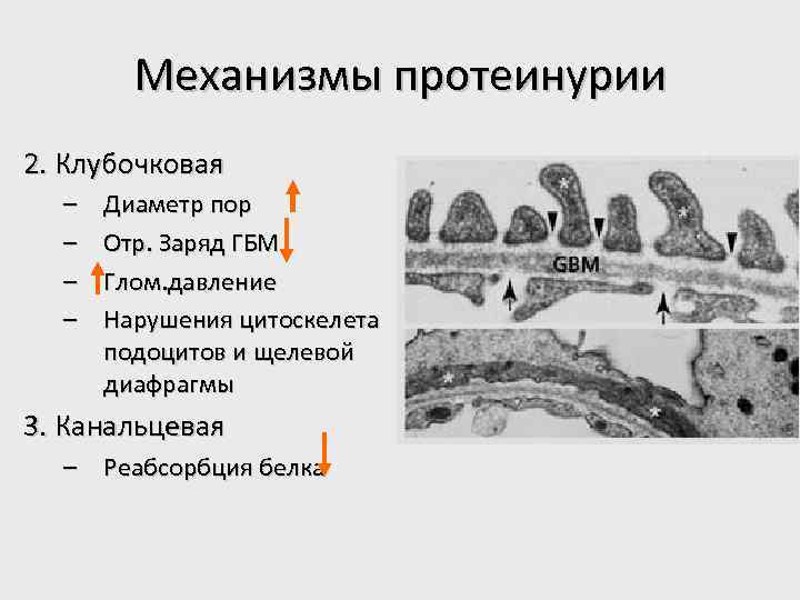 Механизмы протеинурии 2. Клубочковая – – Диаметр пор Отр. Заряд ГБМ Глом. давление Нарушения