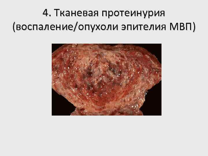 4. Тканевая протеинурия (воспаление/опухоли эпителия МВП) 