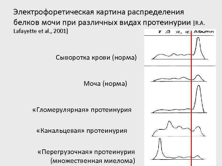 Электрофоретическая картина распределения белков мочи при различных видах протеинурии [R. A. Lafayette et al.