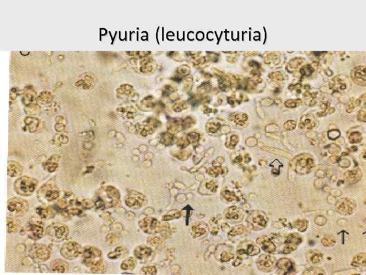 Pyuria (leucocyturia) 