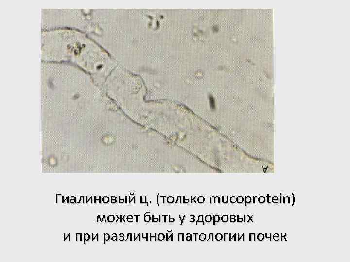 Гиалиновый ц. (только mucoprotein) может быть у здоровых и при различной патологии почек 