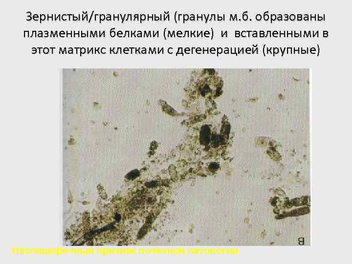 Зернистый/гранулярный (гранулы м. б. образованы плазменными белками (мелкие) и вставленными в этот матрикс клетками