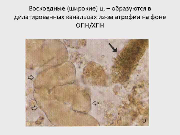 Восковдные (широкие) ц. – образуются в дилатированных канальцах из-за атрофии на фоне ОПН/ХПН 