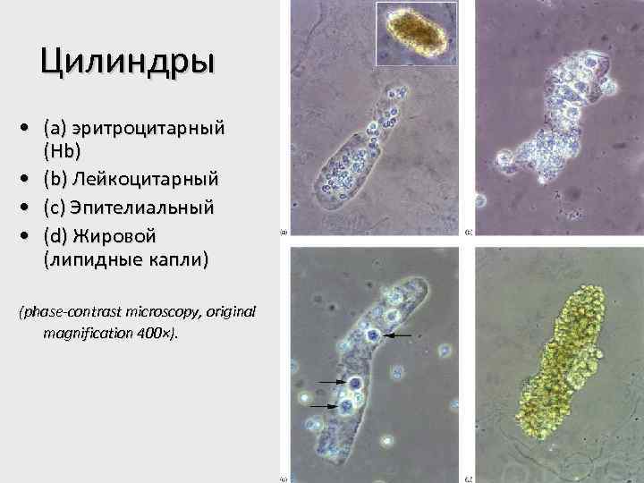 Цилиндры • (a) эритроцитарный (Hb) • (b) Лейкоцитарный • (c) Эпителиальный • (d) Жировой