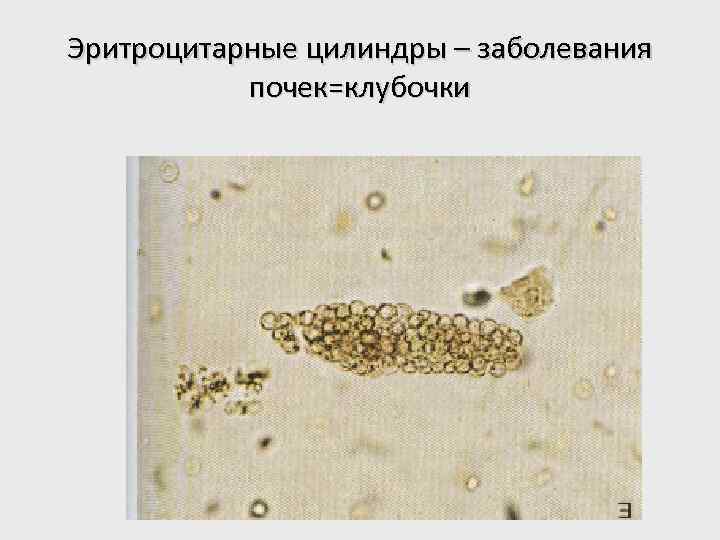 Эритроцитарные цилиндры – заболевания почек=клубочки 