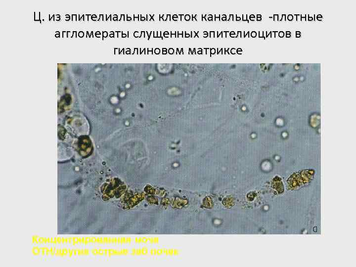 Ц. из эпителиальных клеток канальцев -плотные аггломераты слущенных эпителиоцитов в гиалиновом матриксе Концентрированная моча