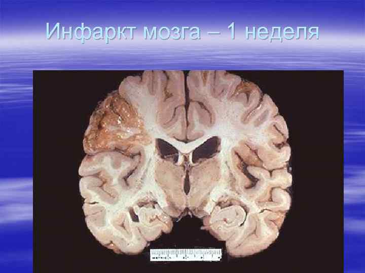 Инфаркт мозга – 1 неделя 