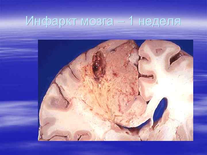 Инфаркт мозга – 1 неделя 