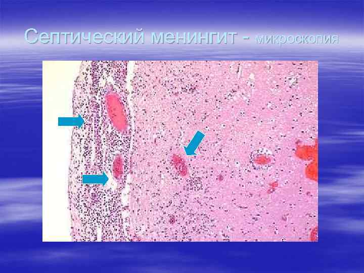 Септический менингит - микроскопия 