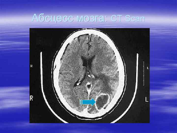 Абсцесс мозга: CT Scan 