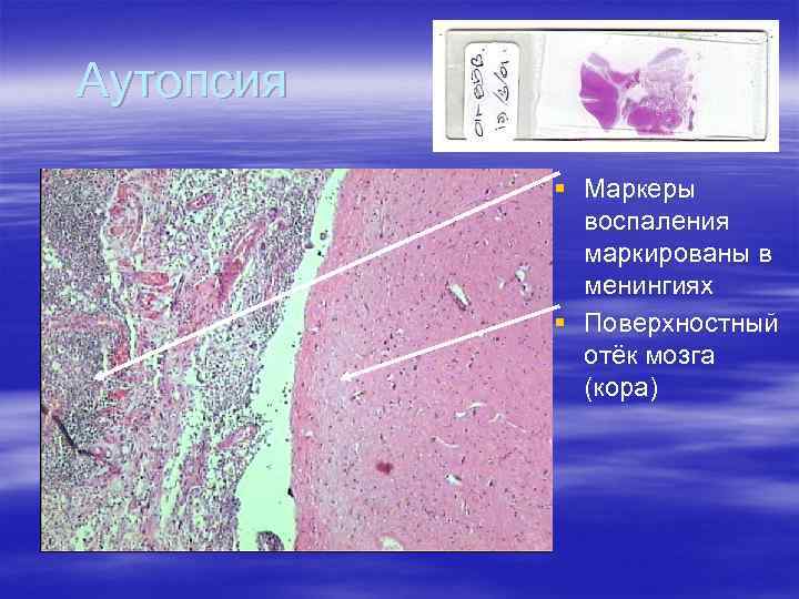 Аутопсия § Маркеры воспаления маркированы в менингиях § Поверхностный отёк мозга (кора) 