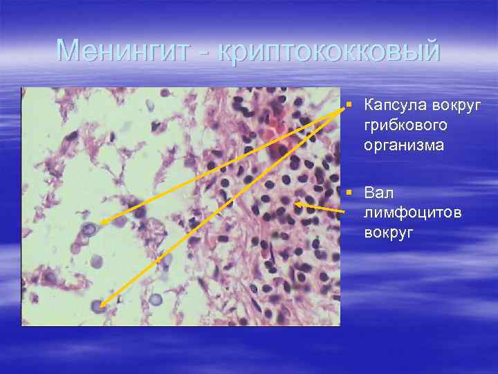 Менингит - криптококковый § Капсула вокруг грибкового организма § Вал лимфоцитов вокруг 