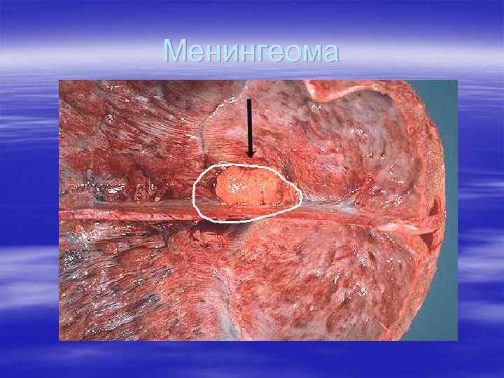 Менингеома 