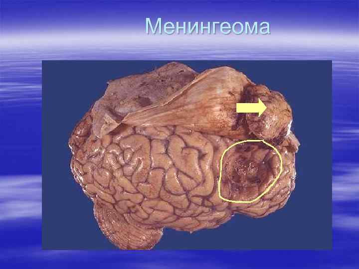 Менингеома 