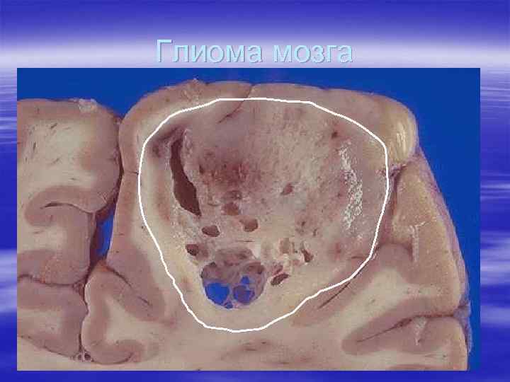 Глиома мозга 