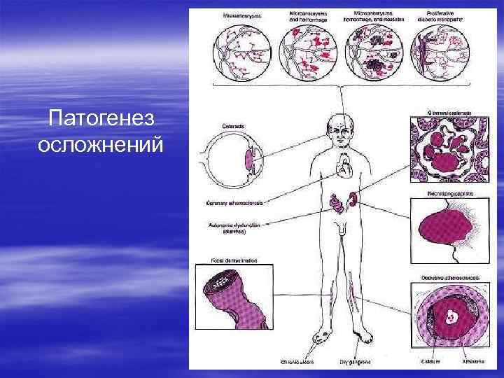 Патогенез осложнений 