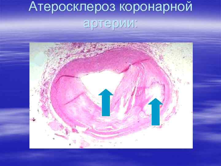 Атеросклероз коронарной артерии: 