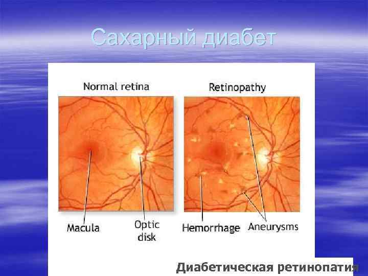 Сахарный диабет Диабетическая ретинопатия 