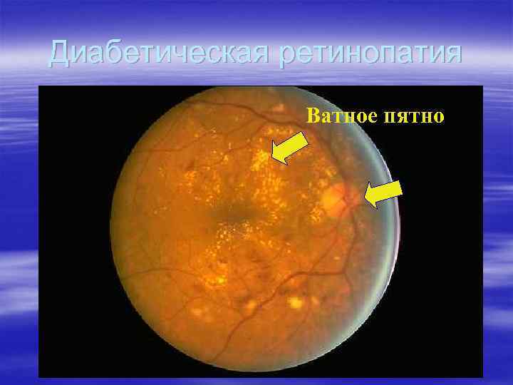 Диабетическая ретинопатия Ватное пятно 