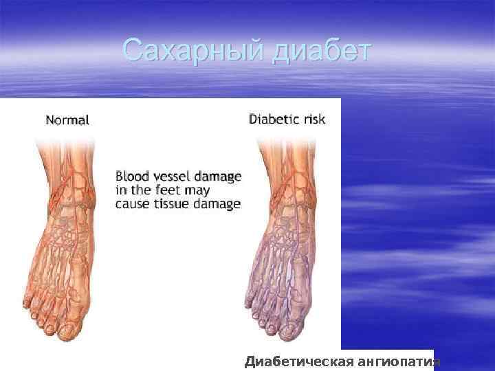 Сахарный диабет Диабетическая ангиопатия 
