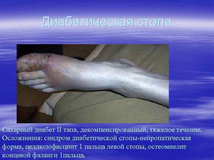 Диабетическая стопа Сахарный диабет II тапа, декомпенсированный, тяжелое течение. Осложнения: синдром диабетической стопы-нейропатическая форма,