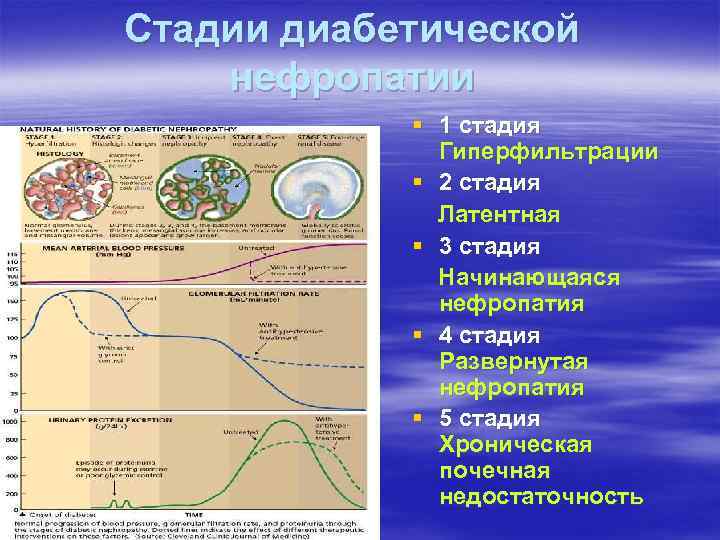 Стадии диабетической нефропатии § 1 стадия Гиперфильтрации § 2 стадия Латентная § 3 стадия