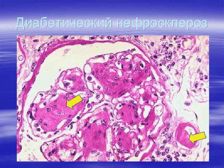 Диабетический нефросклероз 