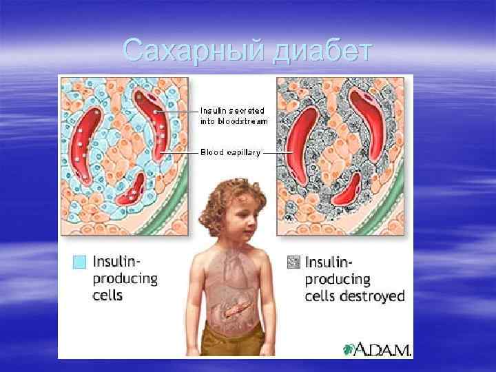 Сахарный диабет 
