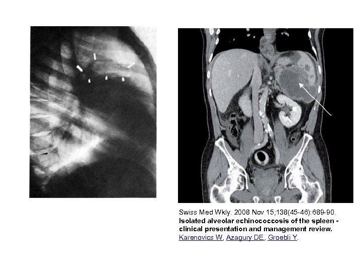 Swiss Med Wkly. 2008 Nov 15; 138(45 -46): 689 -90. Isolated alveolar echinococcosis of