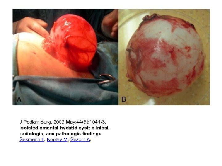 J Pediatr Surg. 2009 May; 44(5): 1041 -3. Isolated omental hydatid cyst: clinical, radiologic,