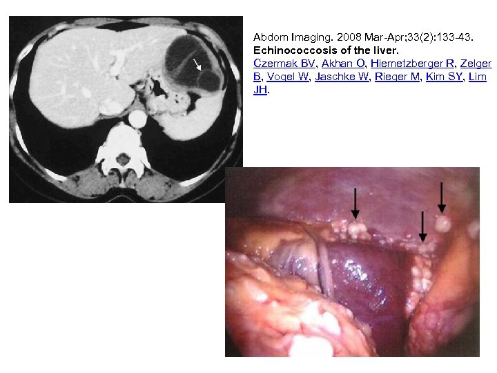 Abdom Imaging. 2008 Mar-Apr; 33(2): 133 -43. Echinococcosis of the liver. Czermak BV, Akhan