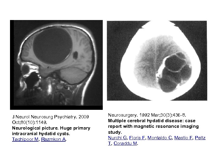 J Neurol Neurosurg Psychiatry. 2009 Oct; 80(10): 1149. Neurological picture. Huge primary intracranial hydatid