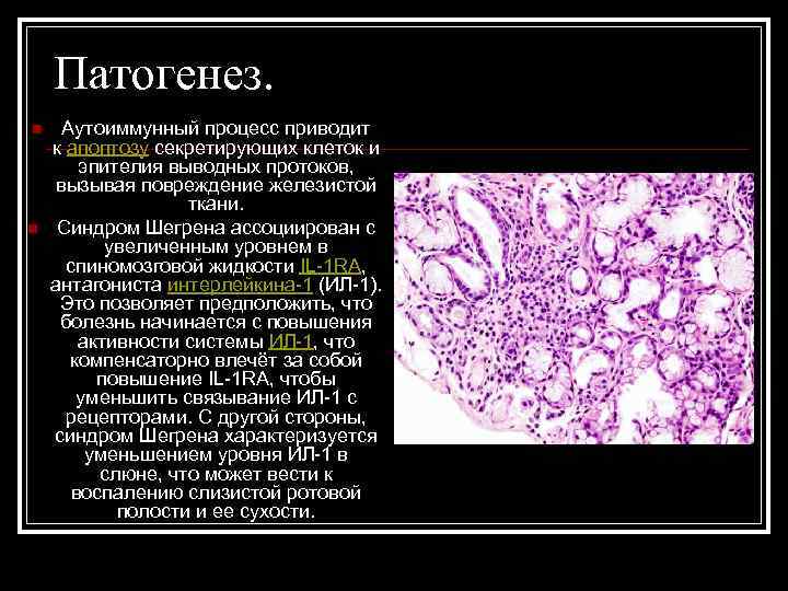 Патогенез. n n Аутоиммунный процесс приводит к апоптозу секретирующих клеток и эпителия выводных протоков,