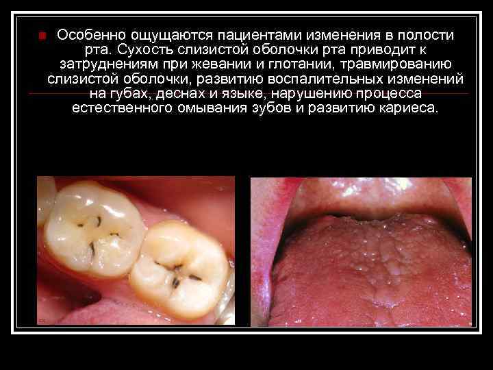 n Особенно ощущаются пациентами изменения в полости рта. Сухость слизистой оболочки рта приводит к