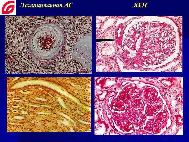 Эссенциальная АГ ХГН 